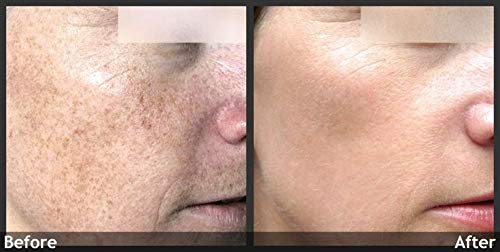70% Glycolic Acid Skin Peel with Free Fan Brush- Unbuffered Professional Grade - Image 5