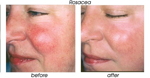 70% Glycolic Acid Skin Peel with Free Fan Brush- Unbuffered Professional Grade - Image 4