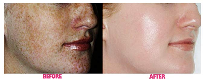 70% Glycolic Acid Skin Peel with Free Fan Brush- Unbuffered Professional Grade - Image 3