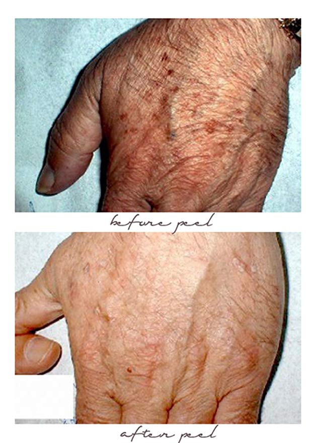 70% Glycolic Acid Skin Peel with Free Fan Brush- Unbuffered Professional Grade - Image 2